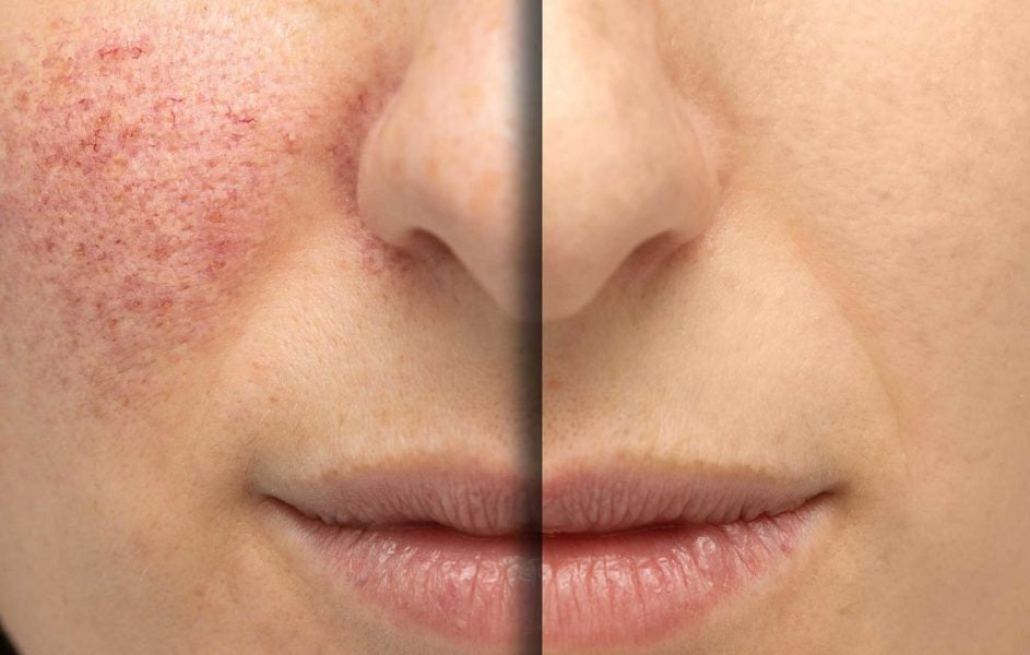 VBeam vascular laser treatment before and after