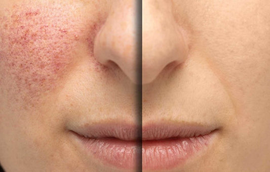 VBeam vascular laser treatment before and after