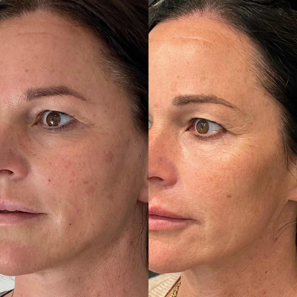 Cool Glow before-and-after laser treatment result