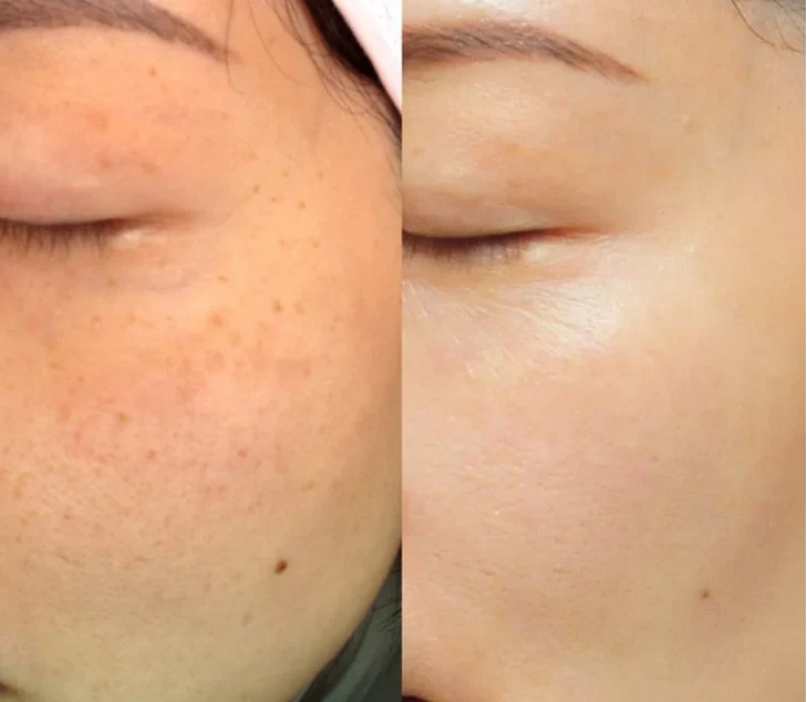 Pico Toning before-and-after treatment result